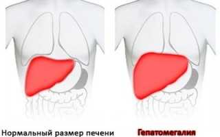Увеличение печени (гепатомегалия)