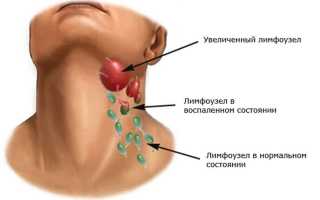 Лимфатические узлы при сифилисе