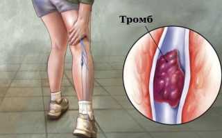 Венозный тромбоз: причины возникновения и возможные риски