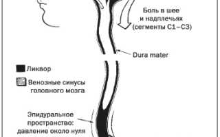 Сильные головные боли после спинальной анестезии