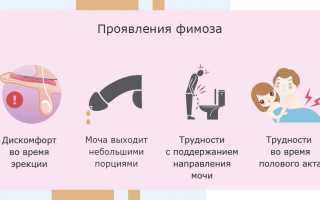 Фимоз: диагностика и лечение