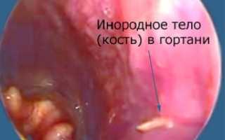 Инородное тело в носоглотке ребенка – одна из причин храпа