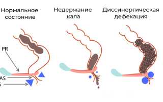 Что делать при недержании кала