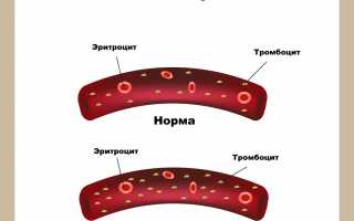Тромбоцитоз