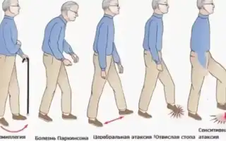 Атаксия – нарушение координации движений