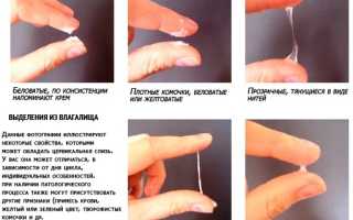 Слизистые выделения из влагалища: норма и патология