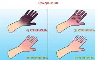 Лечение обморожения верхних конечностей
