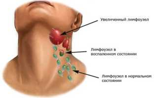 Что делать если болят лимфоузлы