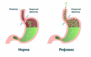 Метеоризм – симптом патологии желудочно-кишечного тракта