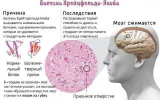 Болезнь Крейцфельдта – Якоба – опасное заболевание нервной системы