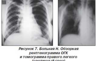 Увеличение паратрахеальных лимфоузлов