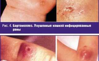 Симптомы и лечение бартонеллеза