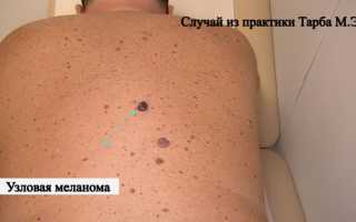 Особенности меланомы лимфатических узлов