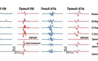 Вызванные потенциалы: суть метода исследования