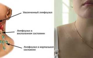 Причины увеличение лимфоузлов на шее