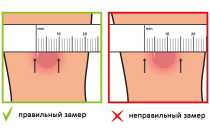 Реакция Манту у детей – нормы и отклонения