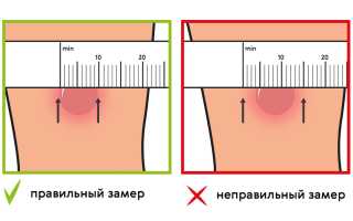 Реакция Манту у детей – нормы и отклонения