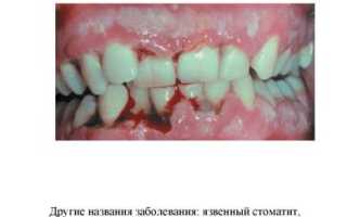 Стоматит Венсана: симптомы и лечение