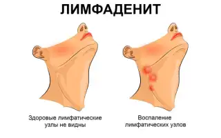 Подколенный лимфаденит: симптомы, диагностика, лечение