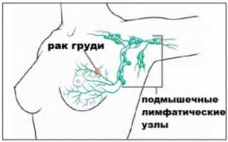 Чем опасно удаление лимфатических узлов