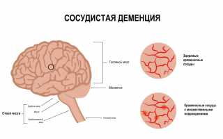 Деменция (приобретенное слабоумие) – симптом когнитивных нарушений