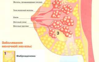Уплотнение в груди: причины и лечение