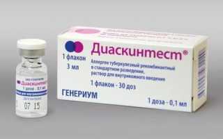 Диаскинтест – проба для диагностики туберкулеза
