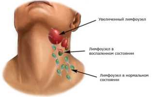 Причины и лечение воспаления лимфоузлов при простуде