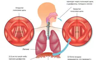 Причины икоты при инсульте