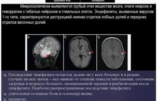 Венесуэльский лошадиный энцефалит – серьезное заболевание животных и людей
