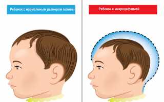 Умственная отсталость (олигофрения)