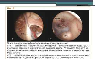 Вентрикулоскопия: суть метода исследования