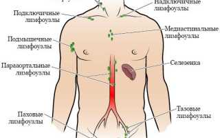 Увеличение парааортальных лимфоузлов