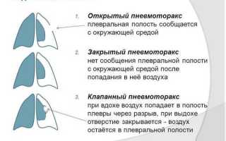 Диагностика и лечение пневмоторакса