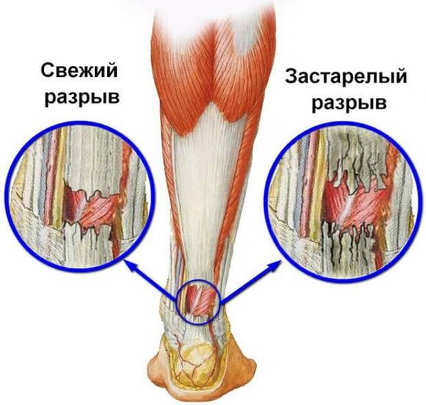 Разница при травме Свежий и застарелый