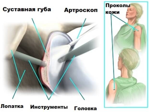 Прокол Места прокола