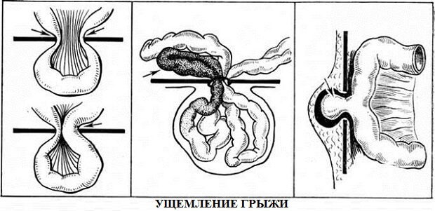 Как выглядит Ущемление
