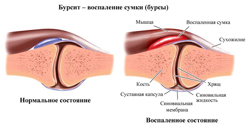 Бурсит у больного человека Бурсит у пациента