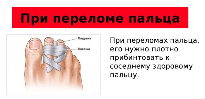 Действия при переломе мизинца Что делать при переломе пальца
