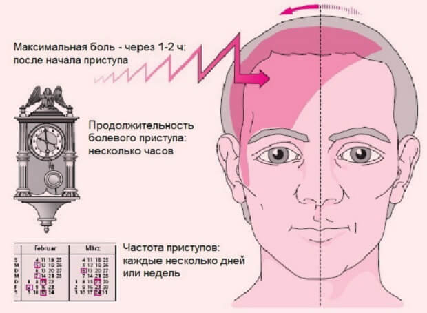Недомогание Мигрень