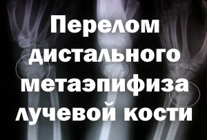 Сломан дистальный метаэпифиз Перелом