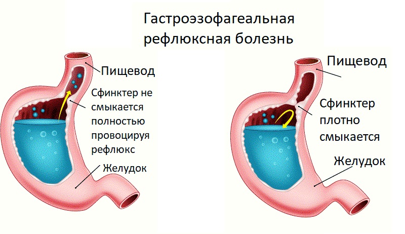 Гастроэзофагеальная рефлюксная болезнь Гастроэзофагеальная рефлюксная патология