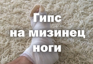 Гипсование мизинца ноги Гипс на мизинец ноги