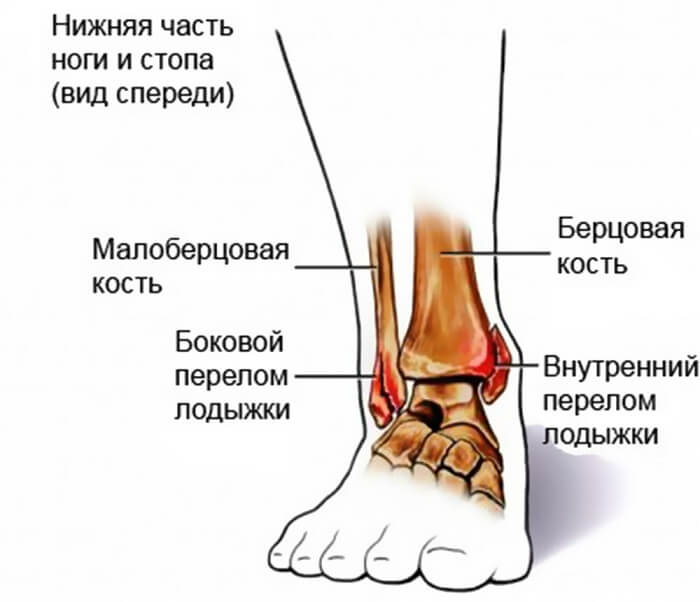 Характеристика сломанной лодыжки Характеристика перелома лодыжки