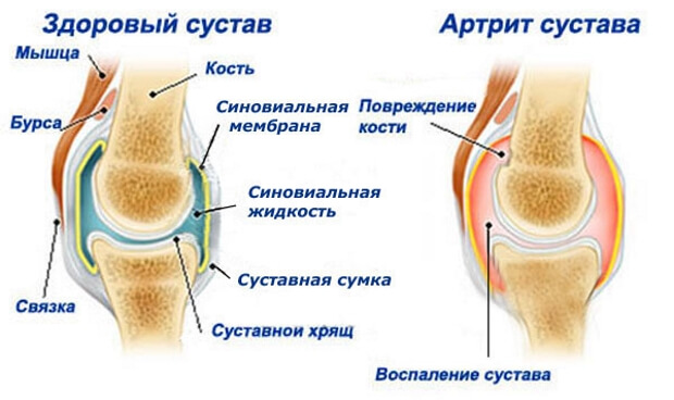 Артрит Артрит коленного сустава