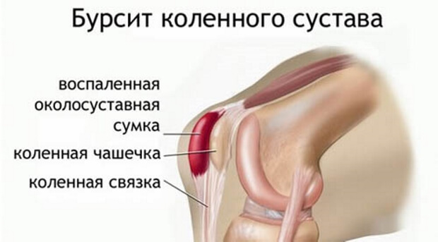 Бурсит Бурсит коленного сустава