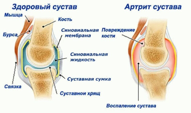 Болезнь Артрит