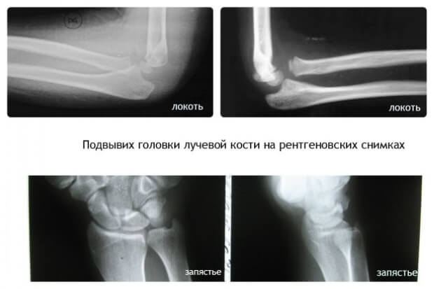 Подвывих Подвывих головки лучевой кости
