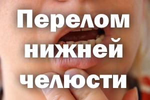 Сломанная нижняя челюсть Перелом нижней челюсти