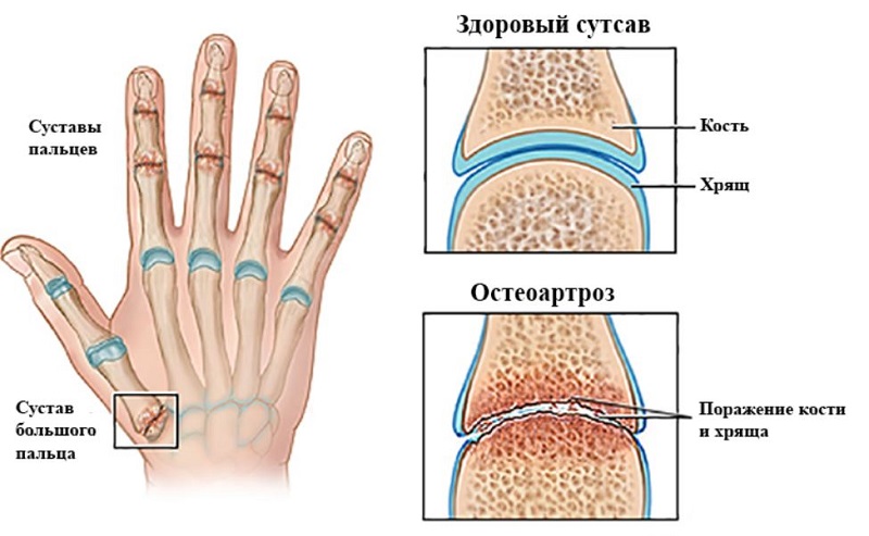 Остеоартроз рук Остеоартроз ручек